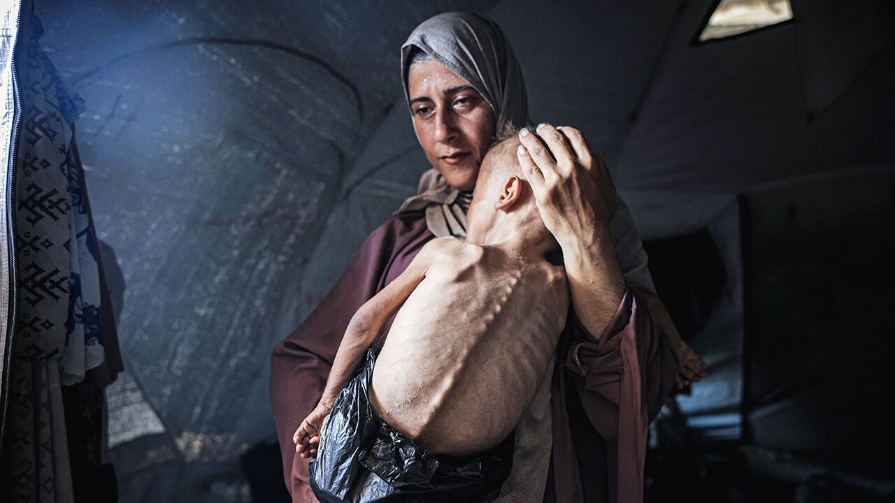 A mother holds her malnourished toddler in Gaza